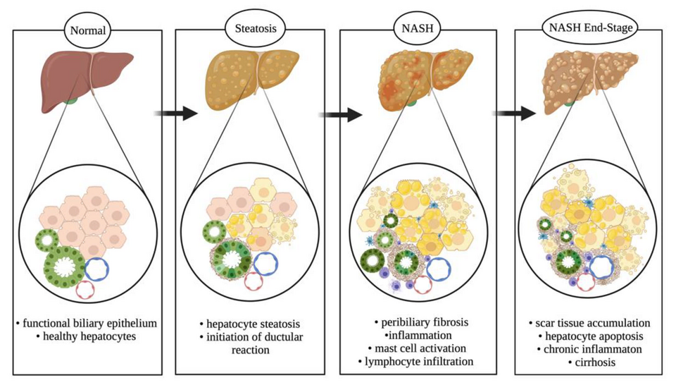 Dietary Guidelines for Managing Fatty Liver Disease: Foods to Avoid