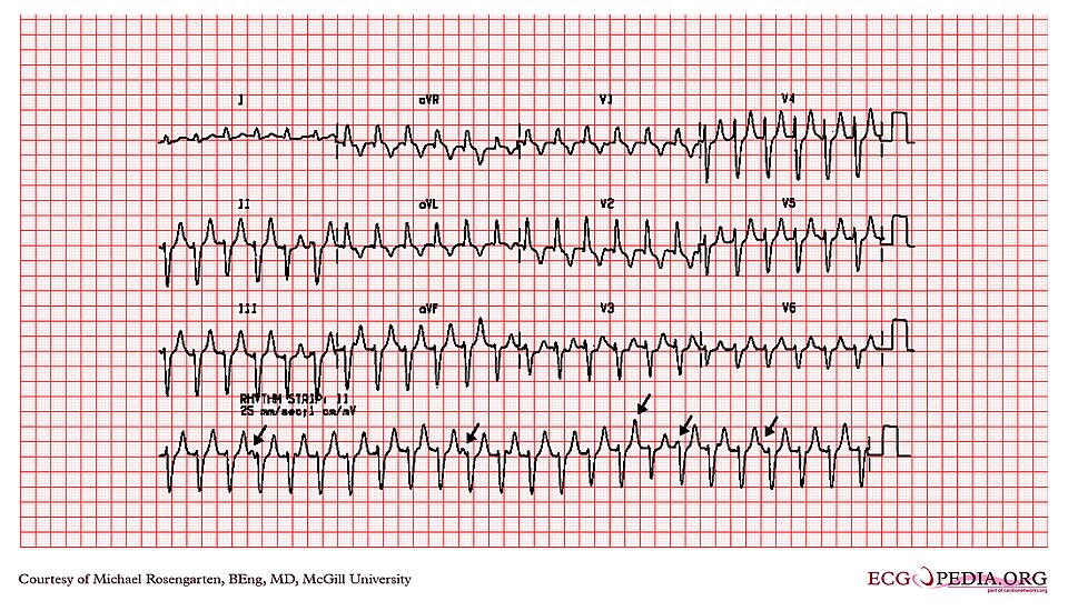 Study Links Night-Time Heart Rhythm Variability to Stroke Risk
