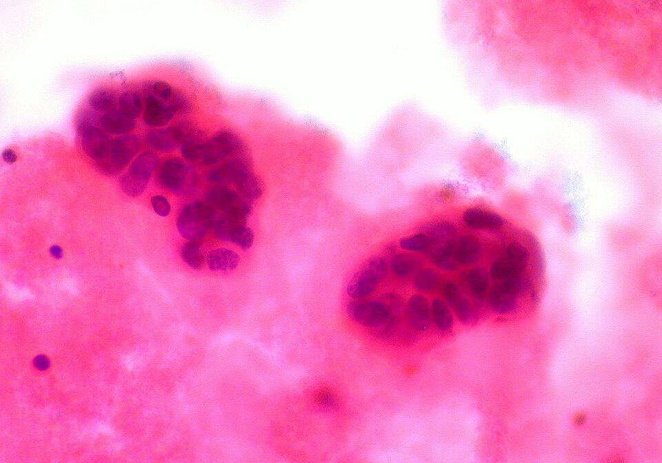 Innovative Study of [177Lu]Lu-NeoB in Advanced Breast Cancer Patients