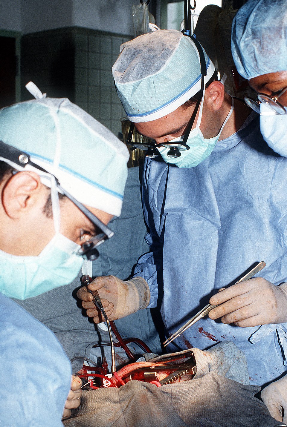 Assessing D-Dimer-to-Albumin Ratio for Predicting Preoperative DVT
