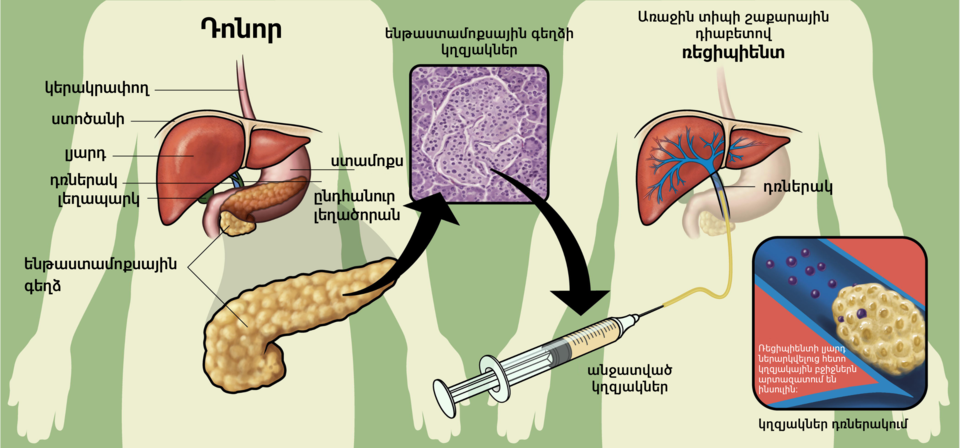 New Pretreatment Technique Enhances Islet Transplant Longevity in Diabetes