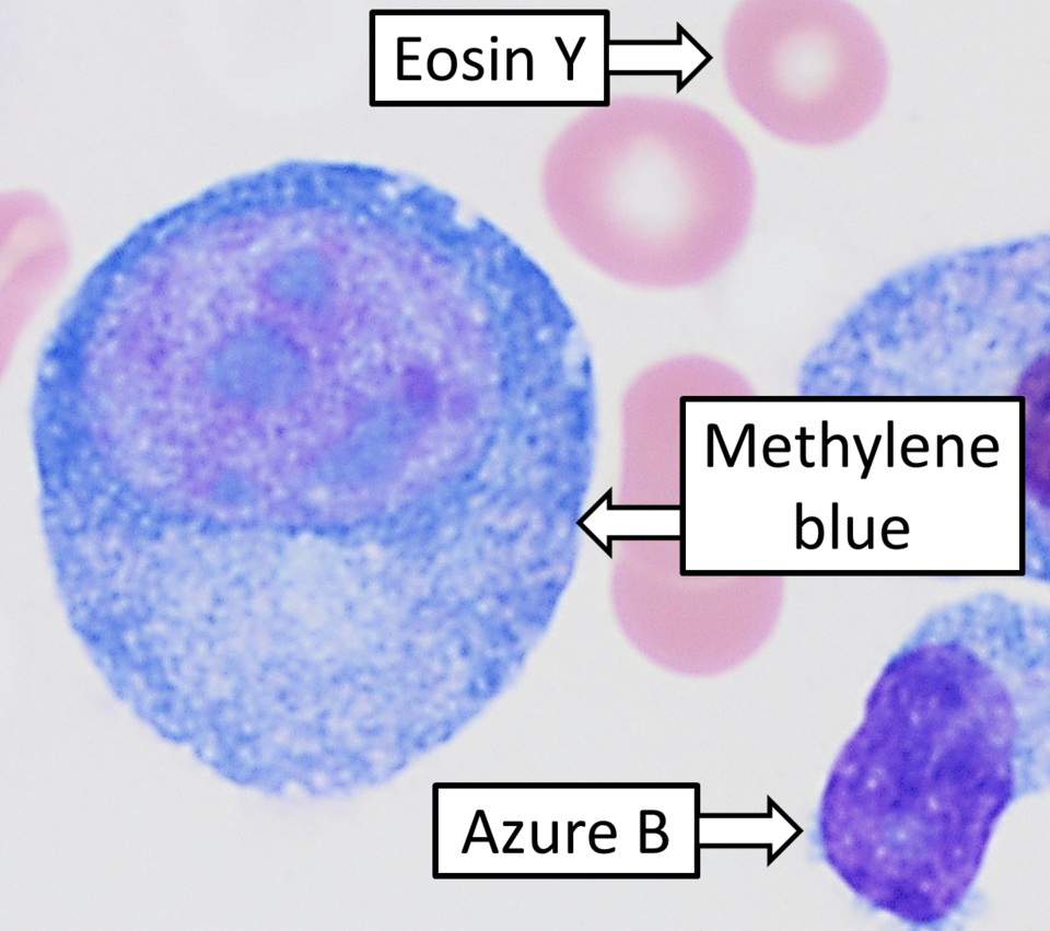 Addressing Disparities in Multiple Myeloma Outcomes and Comorbidities