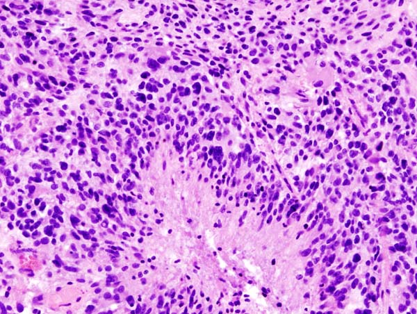 Innovative Strategy Enhances Glioblastoma Immunotherapy Using Gut Microbes