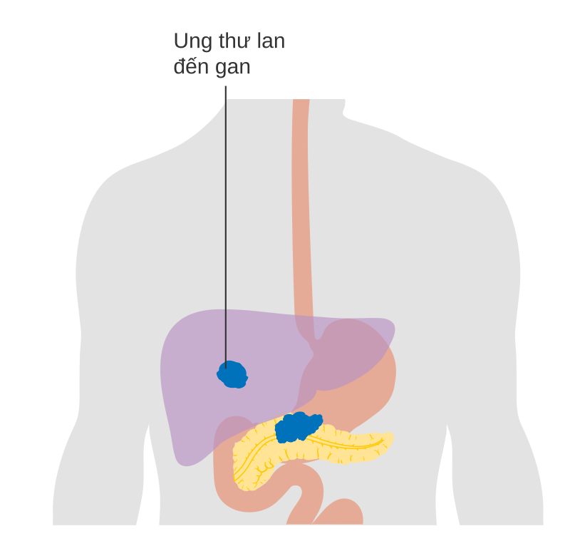 Advancements in Targeting NRG1 and Rare Genetic Drivers in Pancreatic Cancer