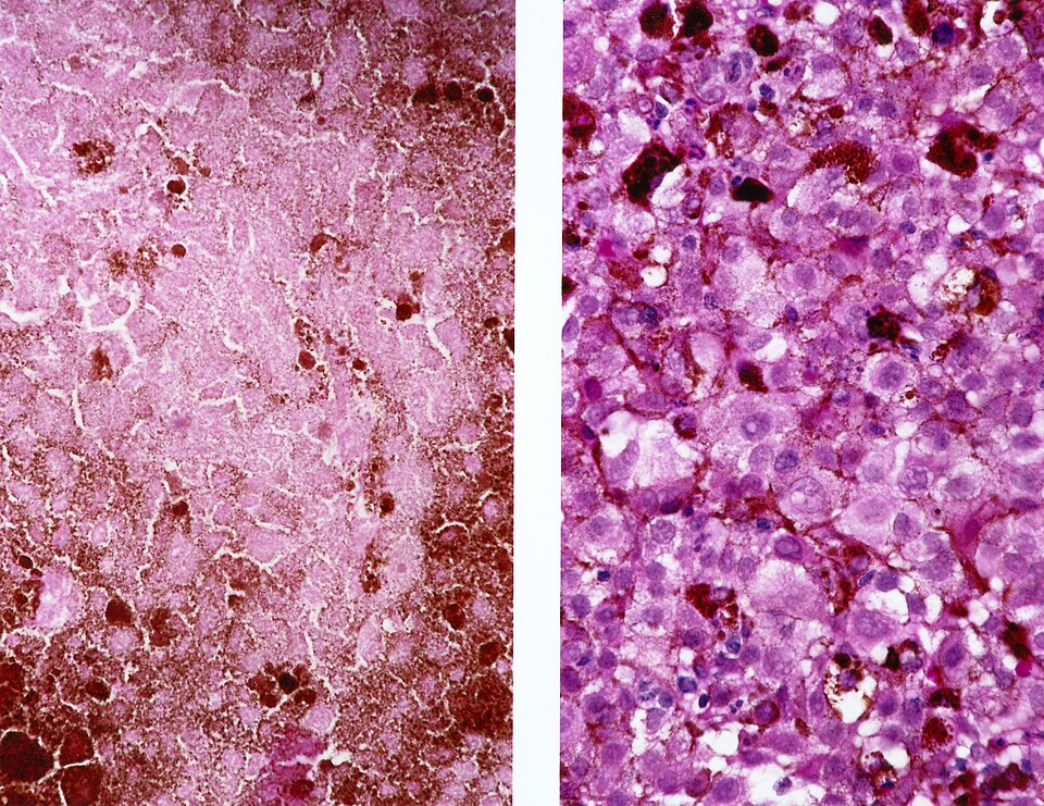 Innovative Immunotherapy Approaches Transforming Melanoma Treatment Landscape