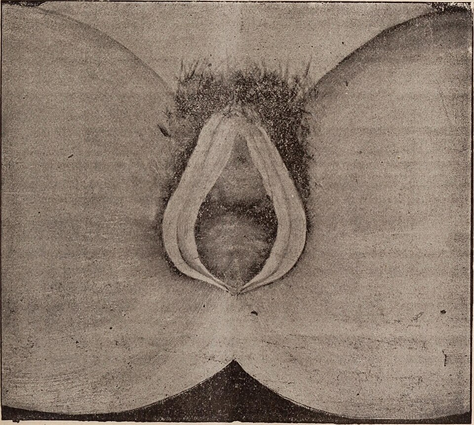 Understanding Bowel Incontinence: A Personal Struggle and Medical Insights