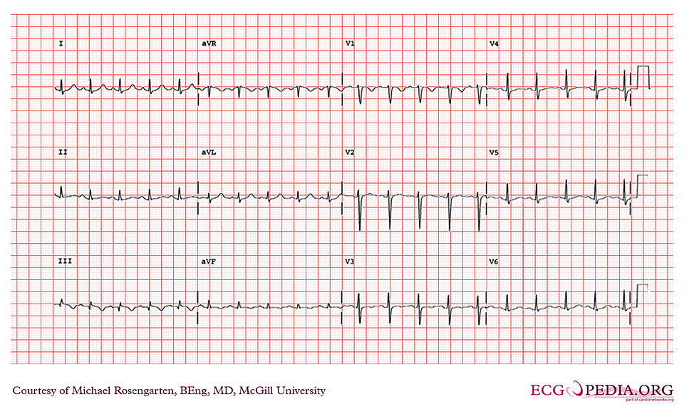 Undiagnosed Early Cardiogenic Shock Linked to Increased Mortality
