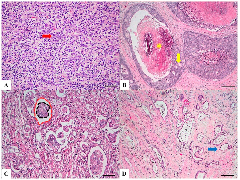 Real-World Insights on Third-Line mCRC Treatment and Molecular Profiling in GI NETs