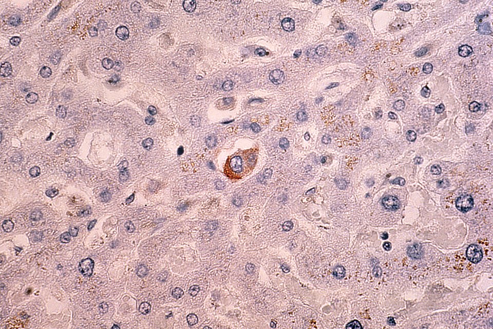 Study Affirms No Significant Link Between Oral Contraceptives and Liver Cancer Risk