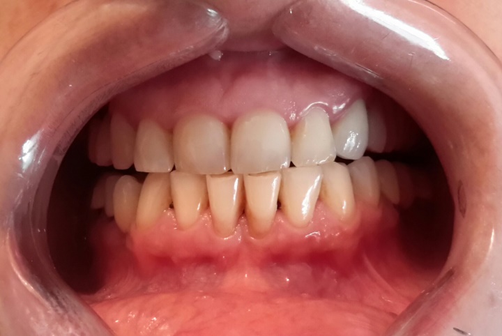 Understanding the Connection Between Gum Disease and Heart Disease