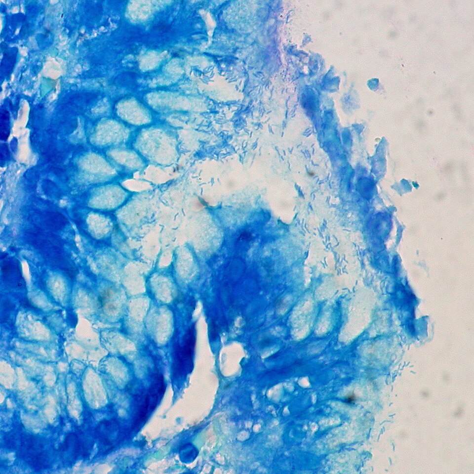 Helicobacter pylori Linked to Nearly 12 Million Stomach Cancer Cases