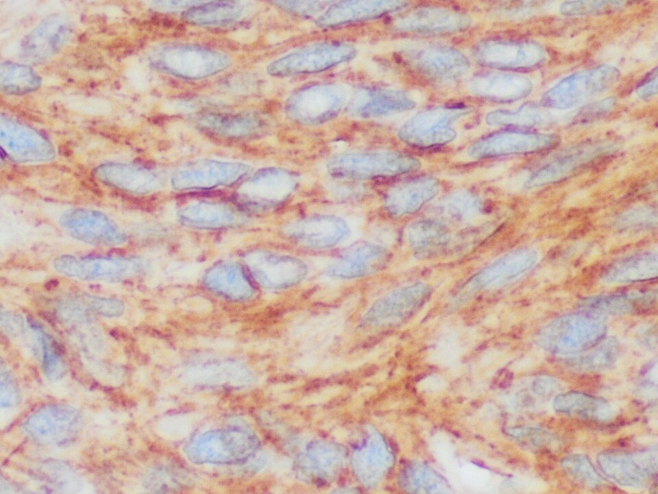 Imatinib Remains Standard of Care for GIST Amid Treatment Challenges