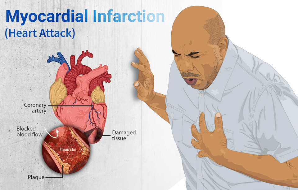 Misleading Hollywood Heart Attack Portrayals: Expert Insights