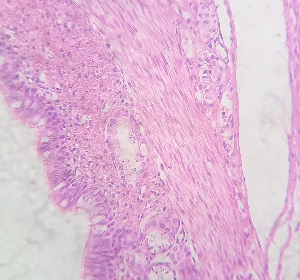 Elevated Cancer Risks for Colorectal Cancer Survivors Highlighted in Study