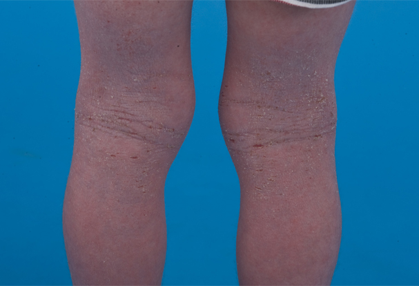 Atopic Dermatitis Linked to Increased Chronic Kidney Disease Risk in Asia
