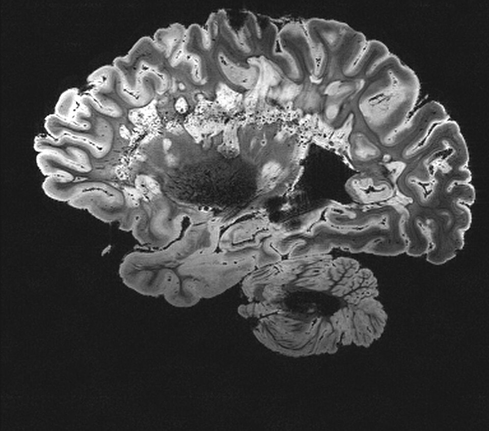 Study Reveals Motion Artifacts' Impact on Stroke MRI Detection Accuracy