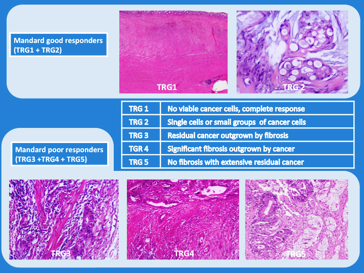 New Study Questions Validity of Surrogate Endpoint in Rectal Cancer Trials