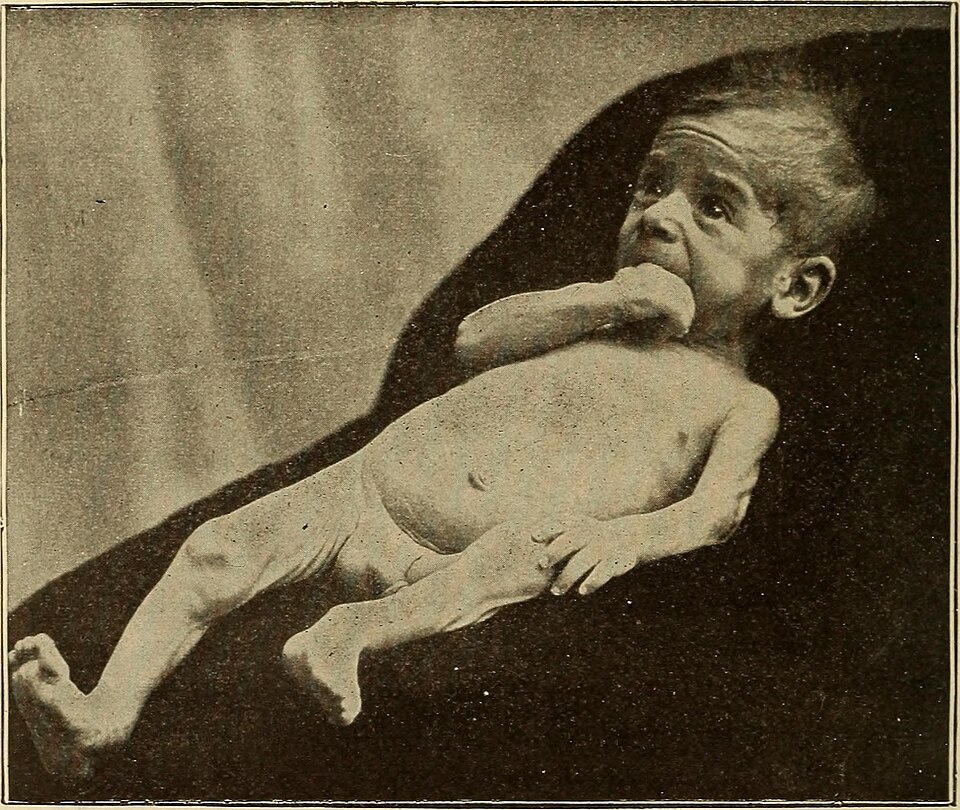 Childhood Gastrointestinal Disorders Linked to Higher Risk of Interstitial Cystitis