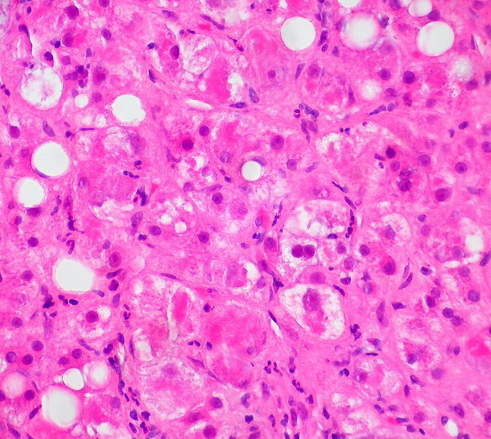 Rising Alcohol Consumption Linked to Increased Liver Disease Risk