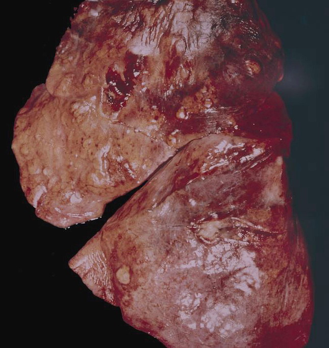 Dual IL-17A/F Blockade Increases Candidiasis Risk in Patients