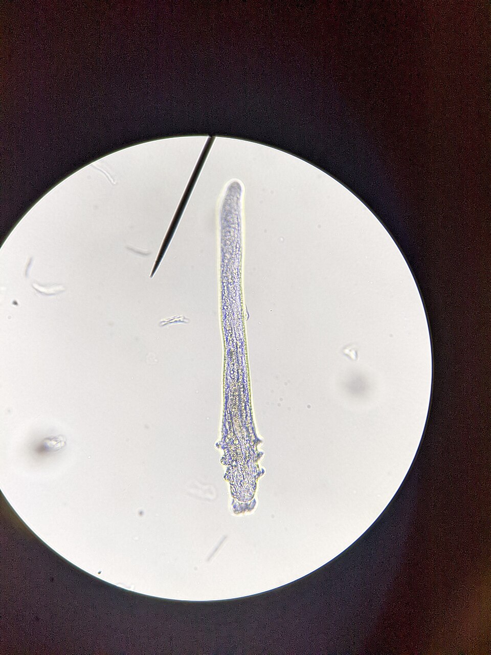 Assessing Demodex Blepharitis in Preoperative Cataract Patients