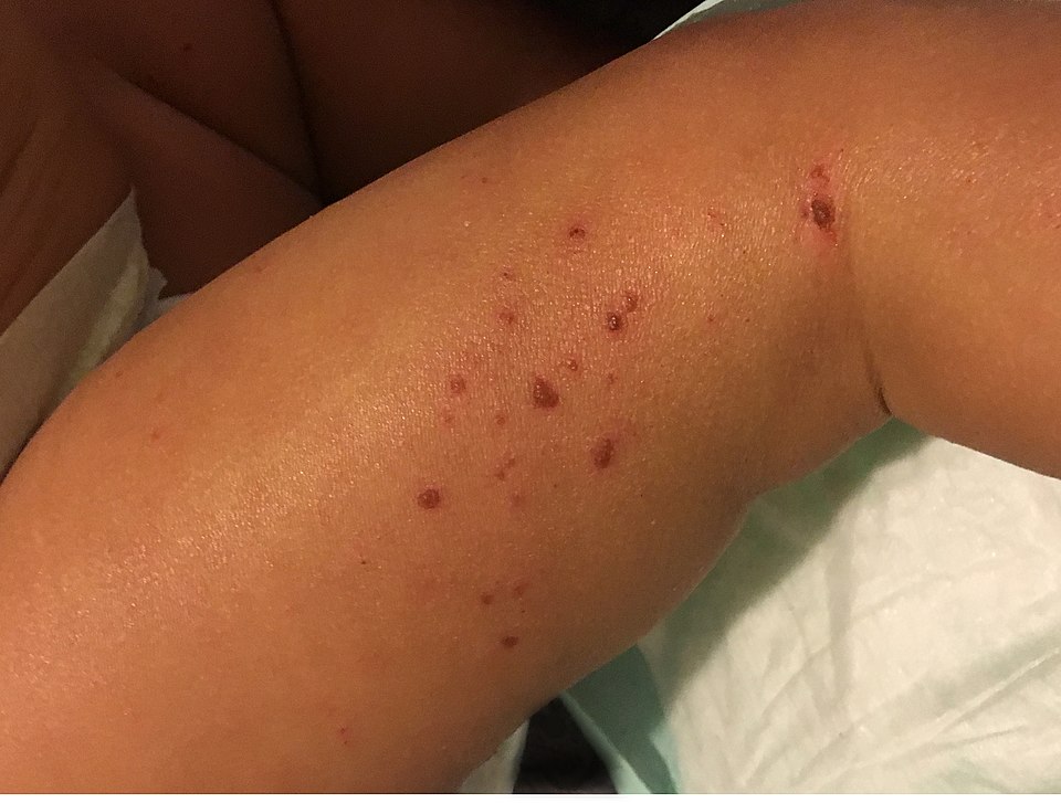 Understanding the Family Burden of Atopic Dermatitis in Young Children