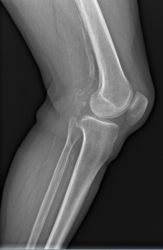 Socioeconomic Disparities in Leg Amputation Rates Due to Arterial Disease