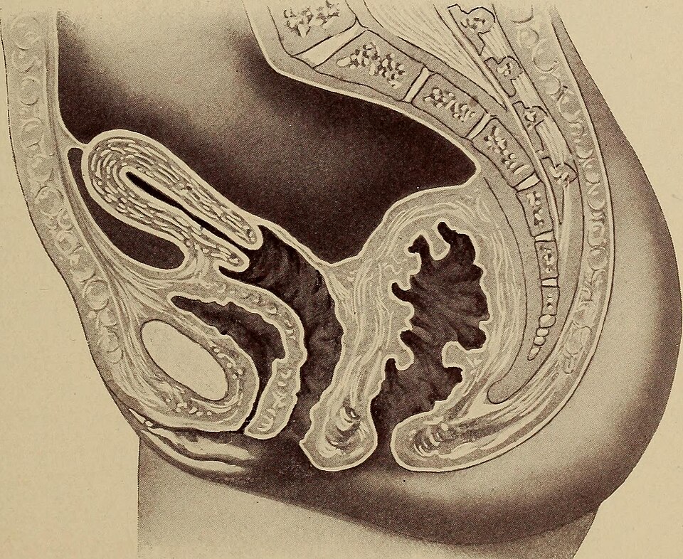 Untreated Genitourinary Symptoms of Menopause Linked to Severe Risks