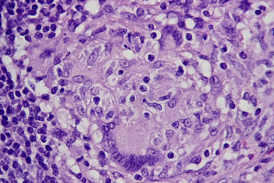 The Financial Strain of Crohn's Disease: Patients Face Tough Choices