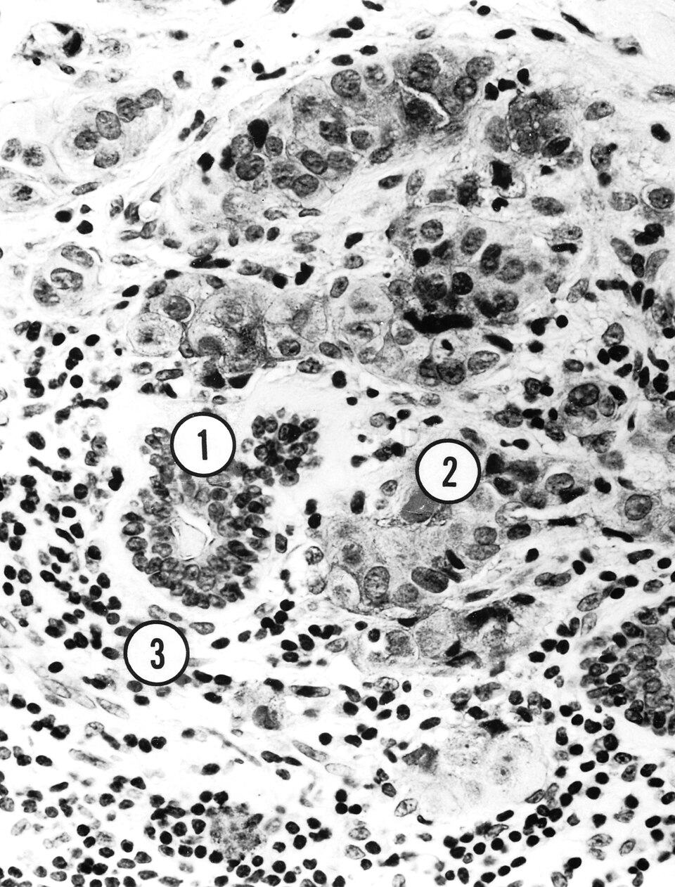 Short Peptides Emerge as Potential Blockers of Breast Cancer Metastasis