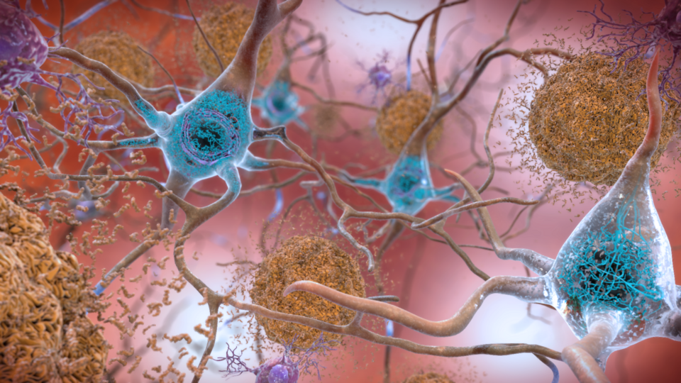 Study Links Late-Life Mood Disorders to Tau and Amyloid Pathology