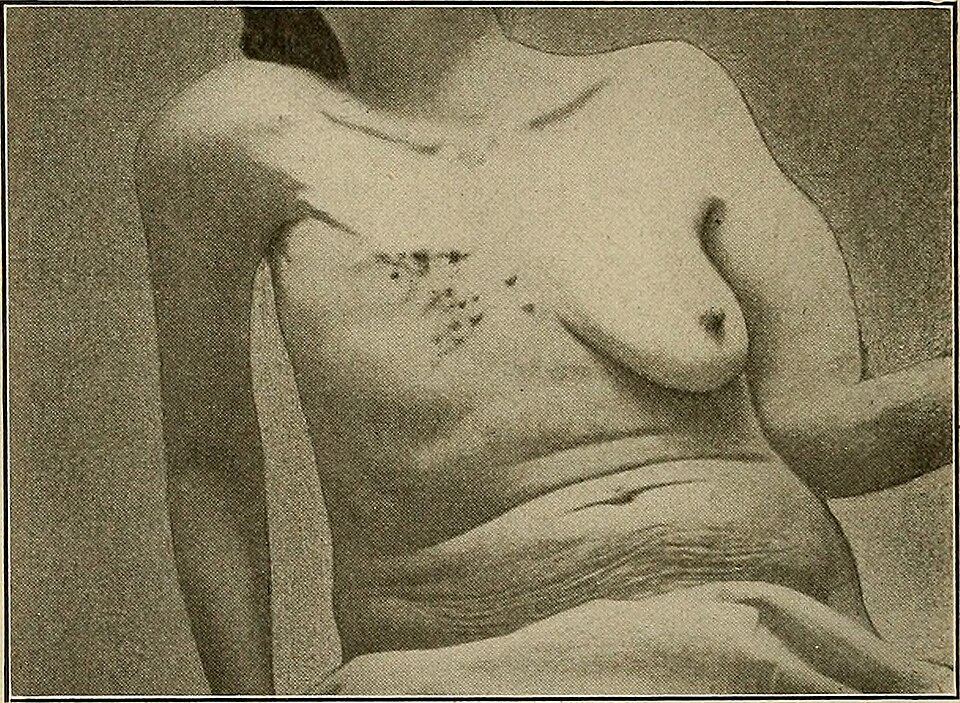Queensland Pioneers Identification of Women with Metastatic Breast Cancer