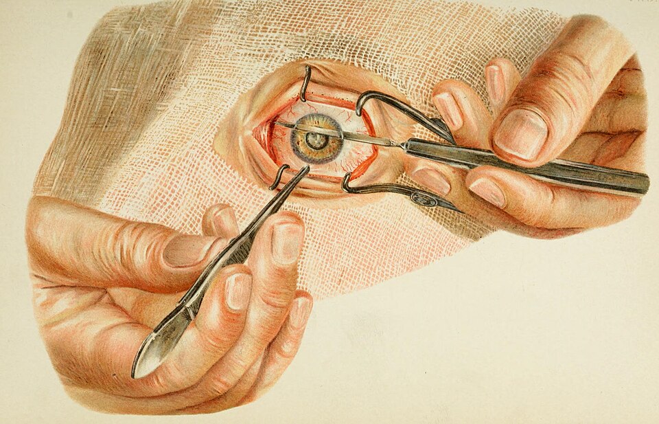 Understanding Eye Health: A Comprehensive Guide to Cataracts