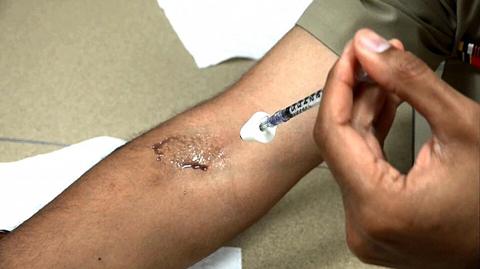 New Insights on Dose Flexibility for Adult Atopic Dermatitis Treatments