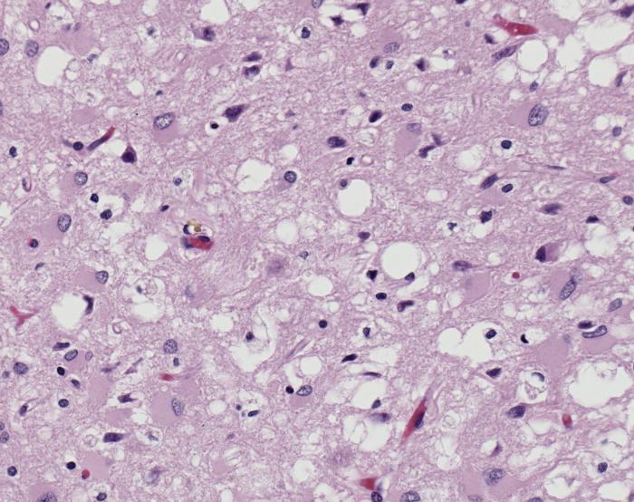 New Insights into Latent Infection Mechanisms of Creutzfeldt-Jakob Disease