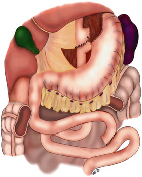Higher BMI Correlates with Increased Complications Post-Bariatric Surgery