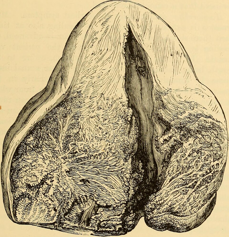 New Study Suggests Low-Risk Thyroid Cancer Patients Can Skip Iodine Treatment