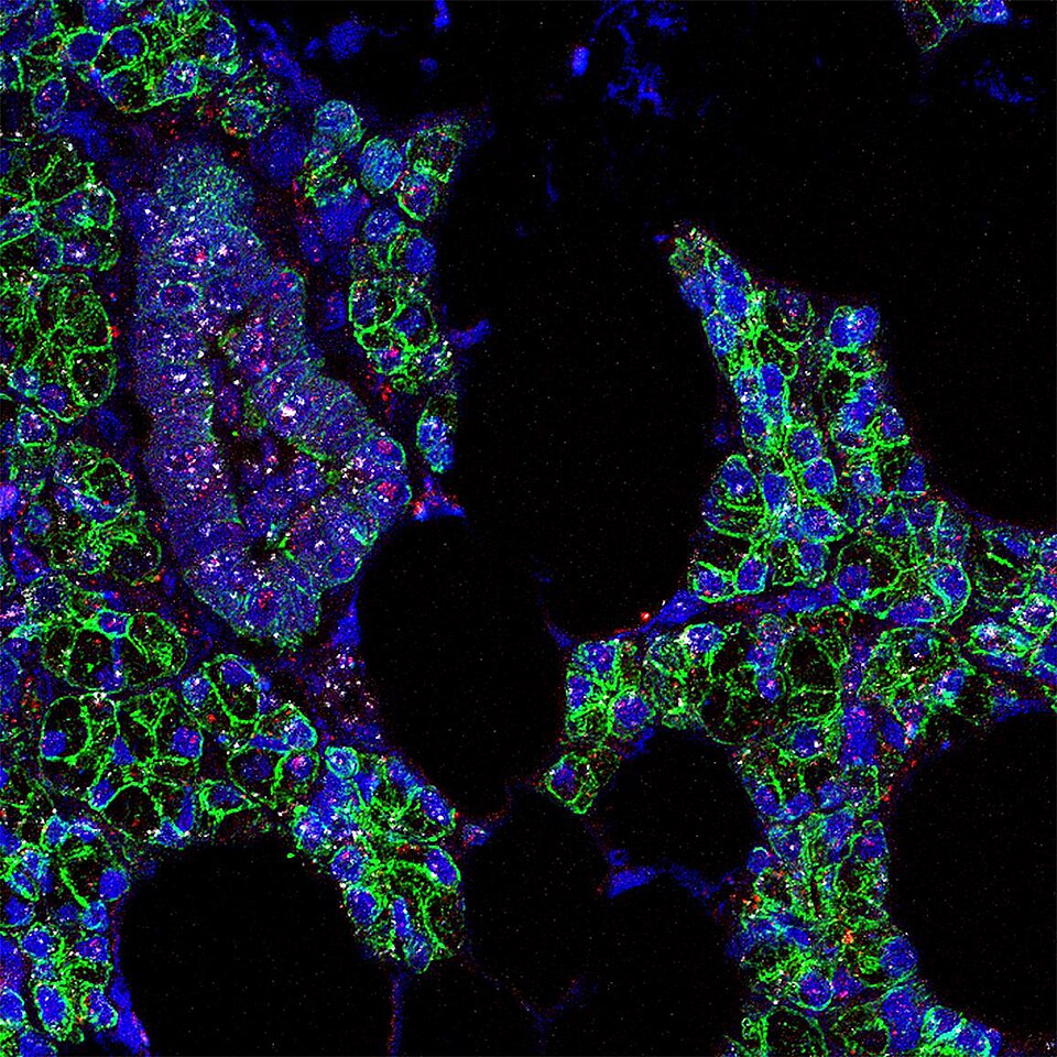 New Study Reveals Long-Term Kidney Impact of COVID-19 Infections