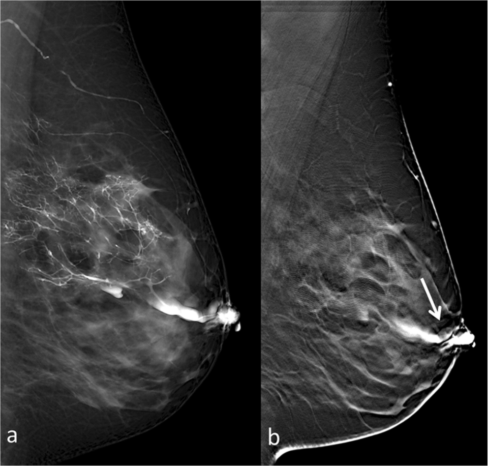 Eliminating Fees for Digital Breast Tomosynthesis: Improved Utilization But Persistent Inequities